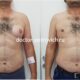 3 стадия гинекомастии фото до и после