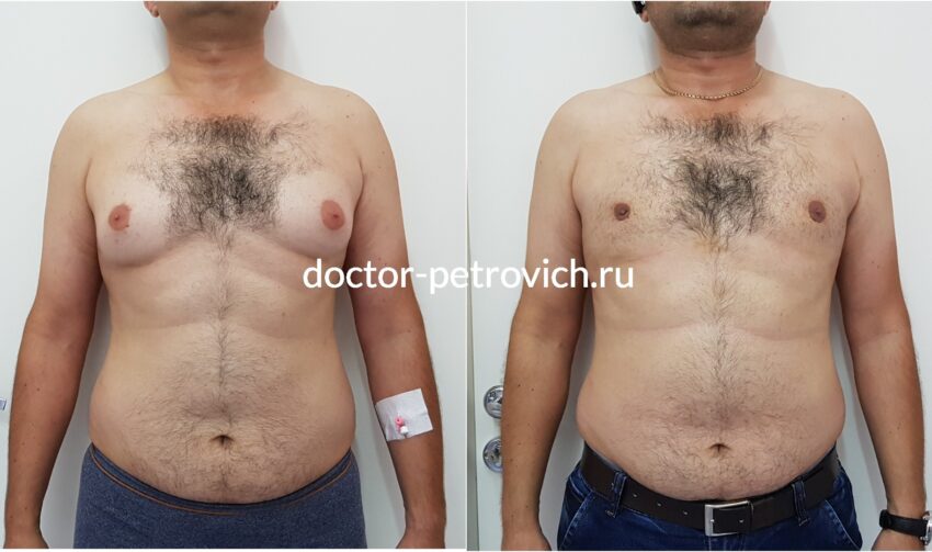 3 стадия гинекомастии фото до и после