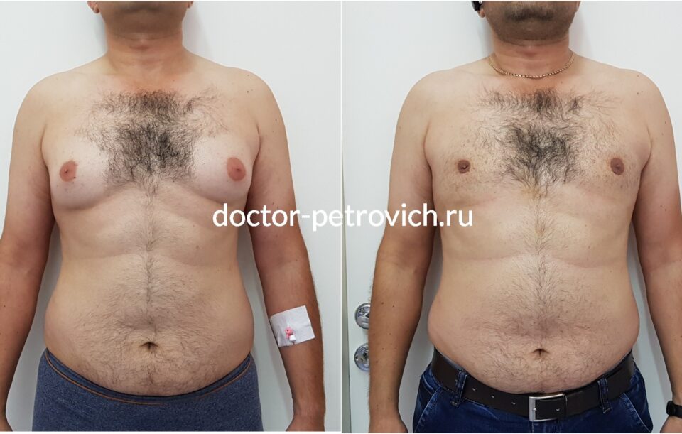 3 стадия гинекомастии фото до и после